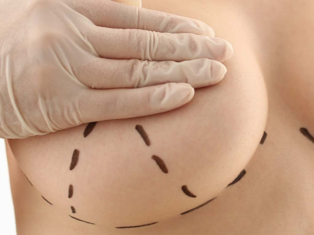 Mulher vestindo uma blusa de decote elegante, exibindo um colo firme, preenchido e rejuvenescido, demonstrando a recuperação da beleza e da projeção dos seios após a cirurgia de Mastopexia na Clínica Orvia.