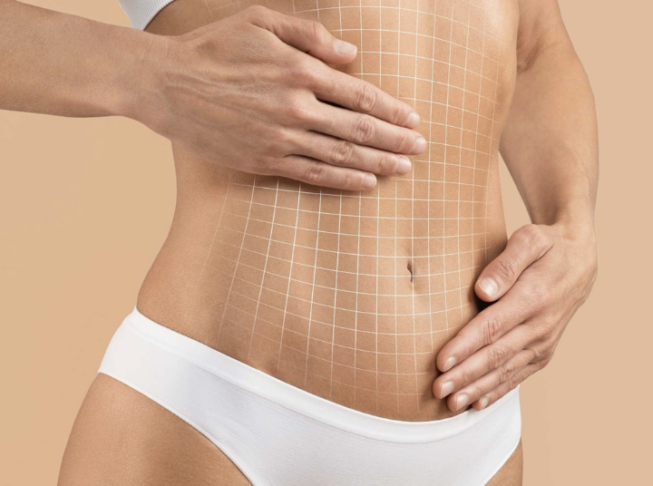 Abdominoplastia em São Paulo realizada na Clínica ORVIA em Moema