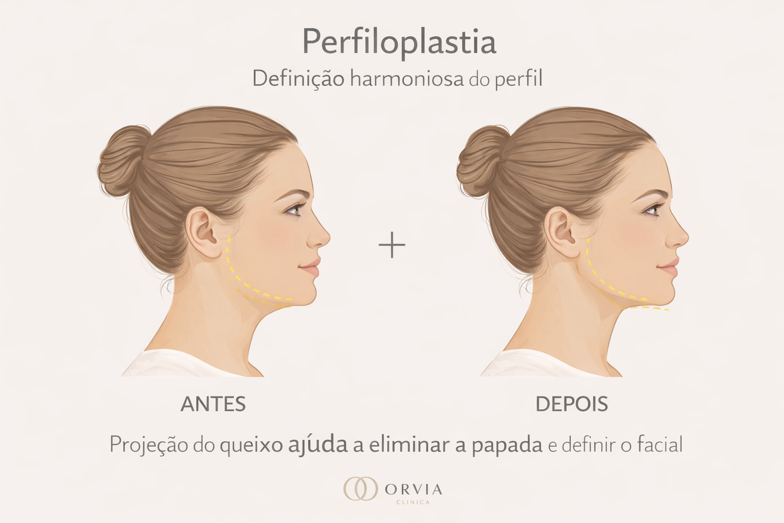 Comparativo de perfil feminino mostrando a eliminação da papada e a projeção do queixo após Lipoaspiração de Papada e Mentoplastia.