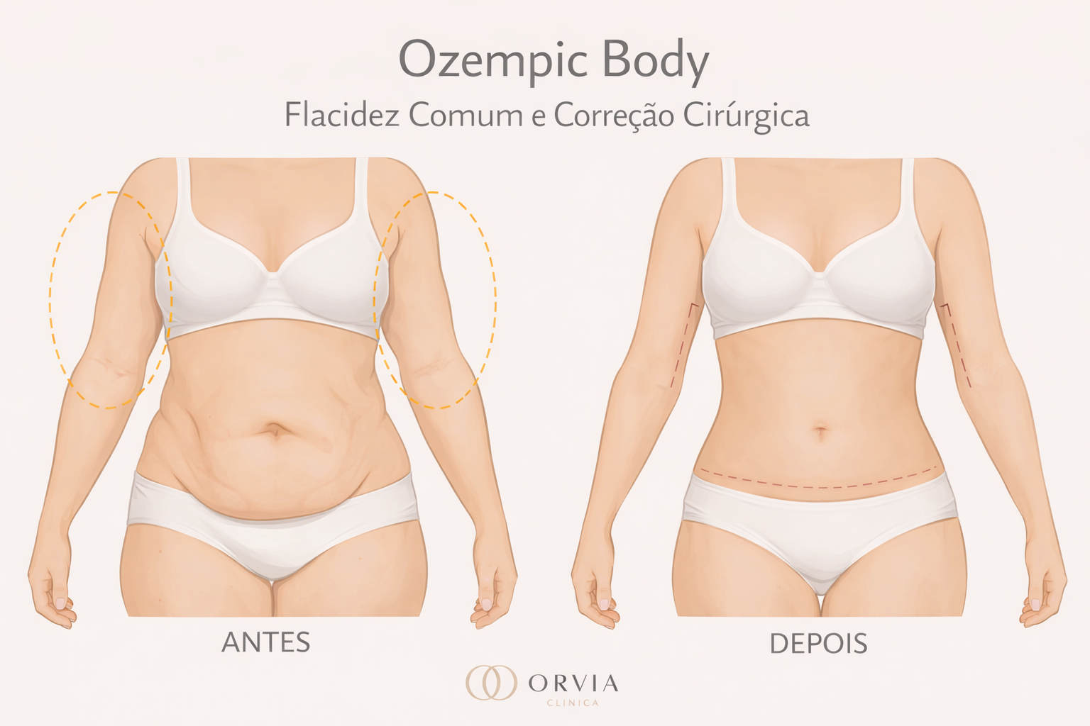 Ilustração comparativa de silhueta feminina com flacidez corporal após emagrecimento rápido e o resultado tonificado após cirurgia plástica reparadora.