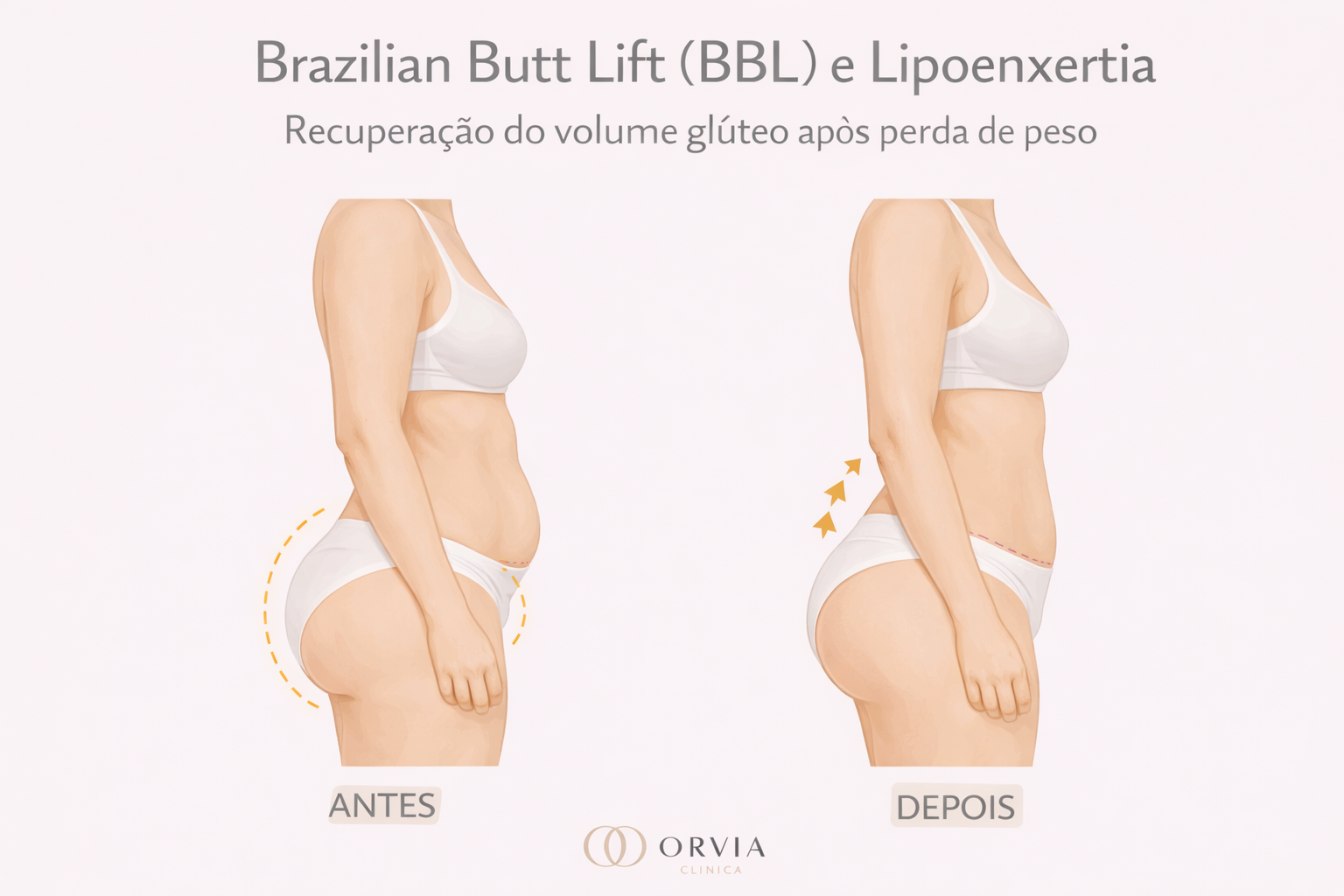 Comparativo de glúteos antes e depois da Lipoenxertia, mostrando o aumento de volume e a melhora do contorno corporal após enxerto de gordura.