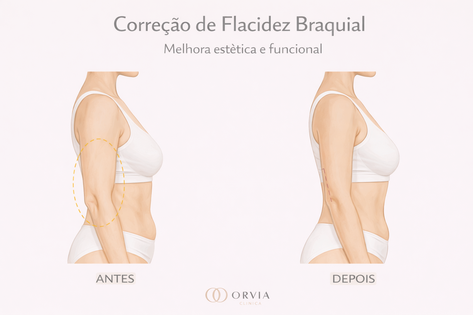 Comparativo de braços femininos, mostrando a remoção do excesso de pele (tchauzinho) e o contorno definido após cirurgia de Braquioplastia.