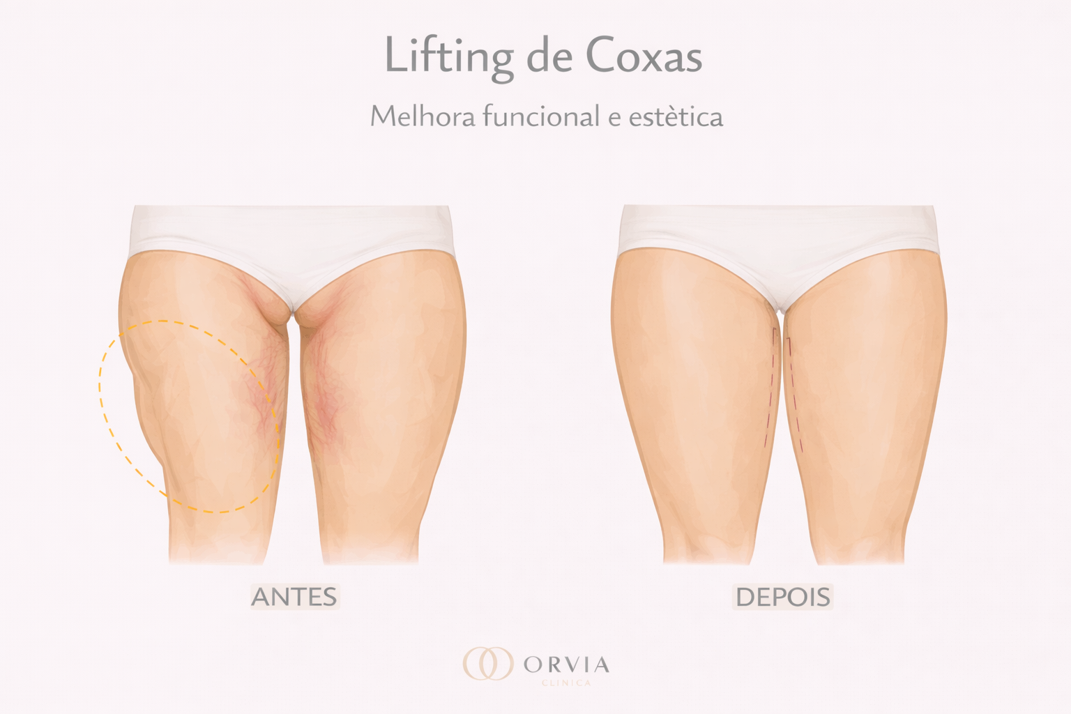 Ilustração médica demonstrando a remoção de pele na parte interna das coxas através da Cruroplastia, melhorando o contorno e evitando atrito.