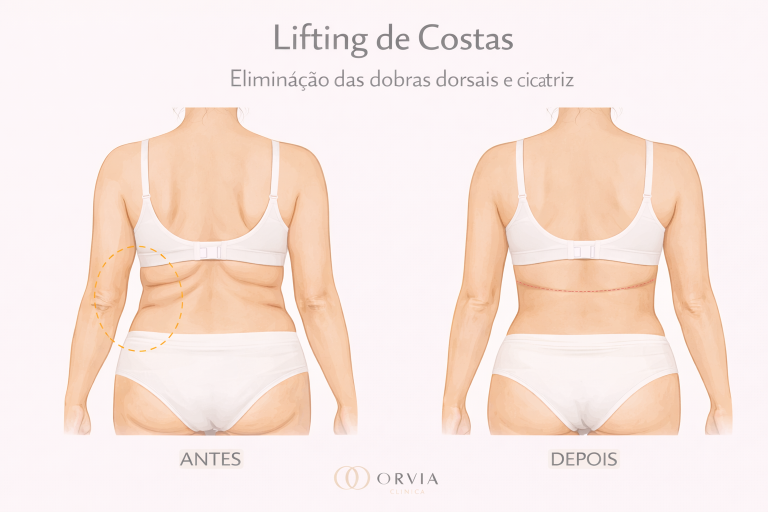 Mulher de costas mostrando o dorso liso e sem dobras de pele após cirurgia de Torsoplastia, com cicatriz escondida na linha do sutiã.