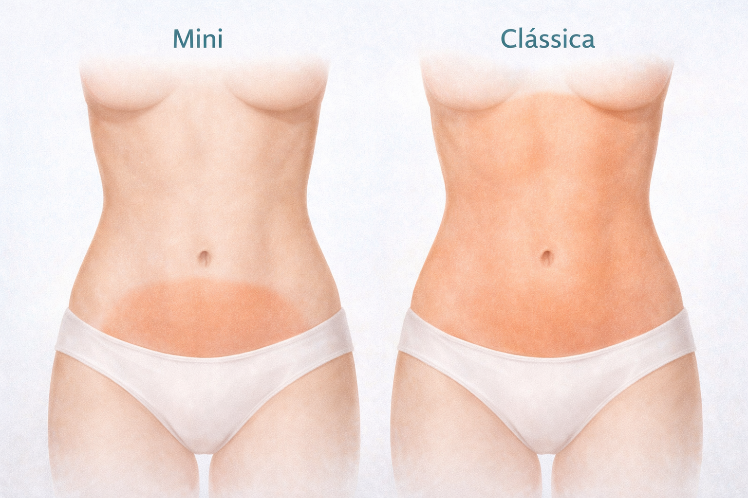 Diagrama ilustrativo comparando a área de atuação da Mini Abdominoplastia (apenas abaixo do umbigo) versus Abdominoplastia Clássica (abdômen total).