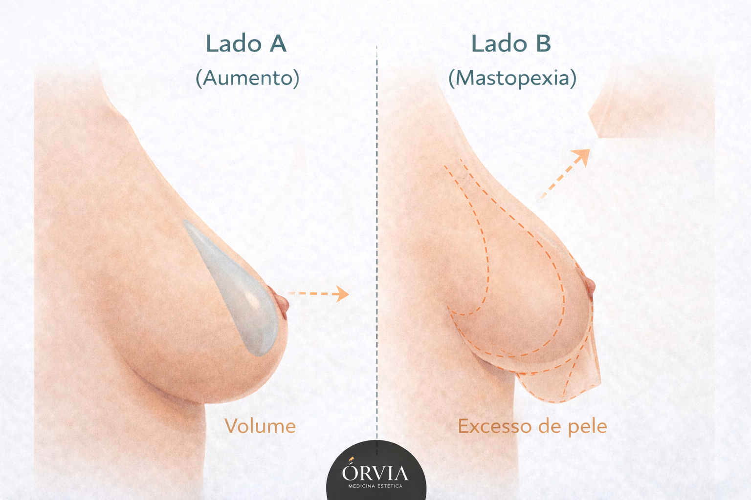 Ilustração médica comparativa mostrando que o Aumento de Mamas (Silicone) adiciona volume, enquanto a Mastopexia (Lifting) remove pele flácida e levanta a mama caída.