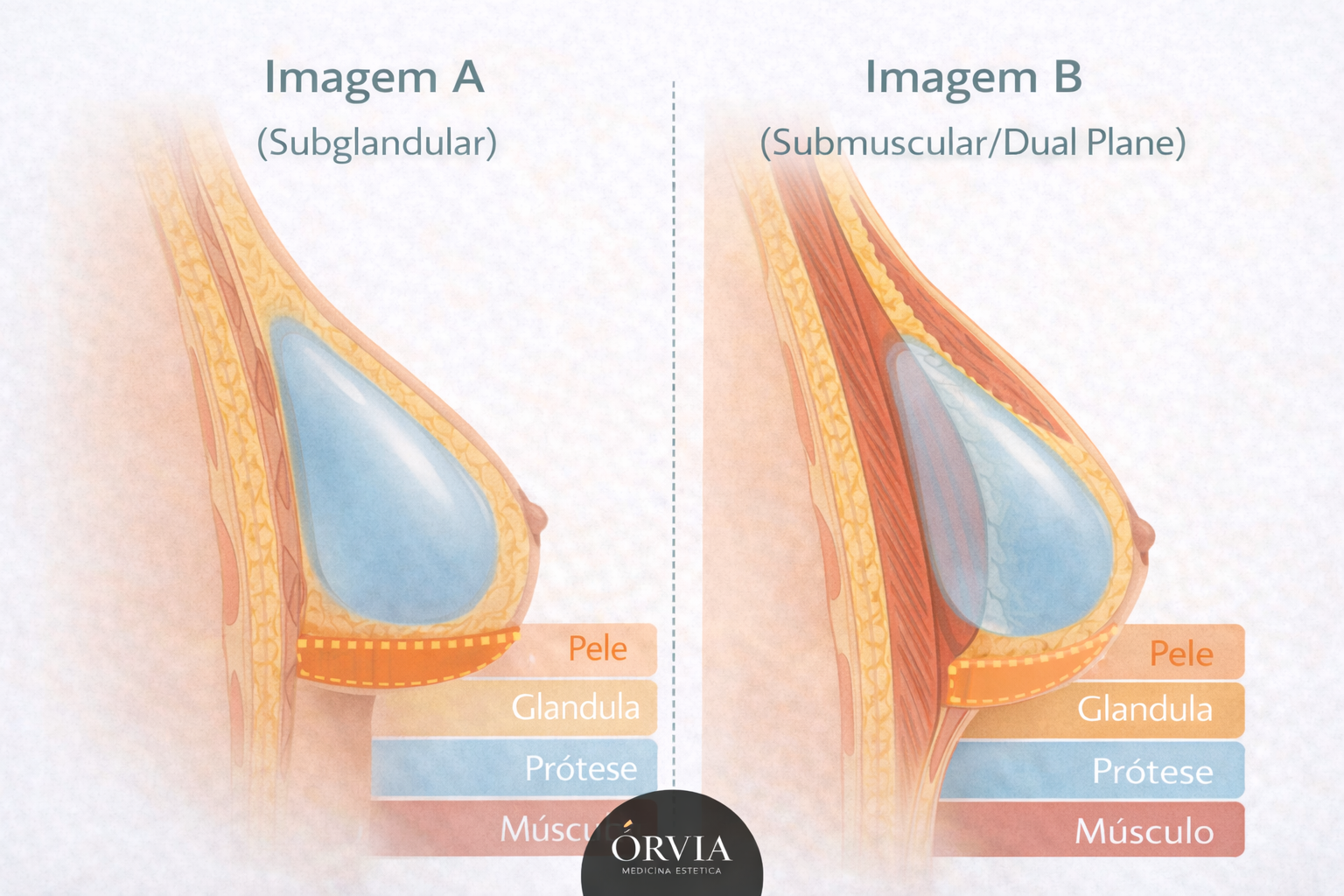 Ilustração médica comparativa em corte lateral: lado esquerdo mostra prótese de silicone por cima do músculo (subglandular) e lado direito mostra prótese parcialmente coberta pelo músculo (submuscular/dual plane).