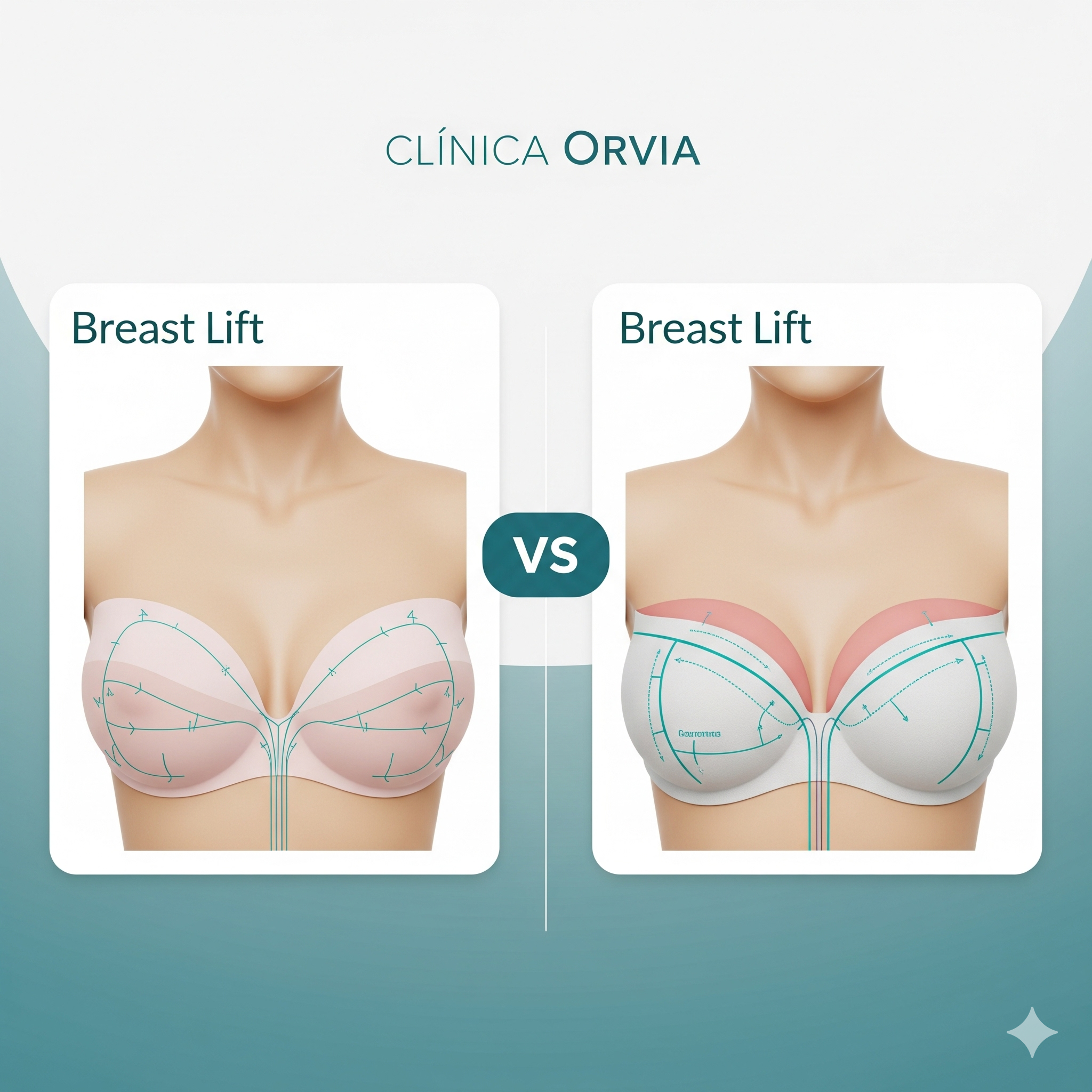Comparativo do colo feminino antes e depois da Mastopexia pos parto, demonstrando o levantamento e o preenchimento dos seios esvaziados após a amamentação.