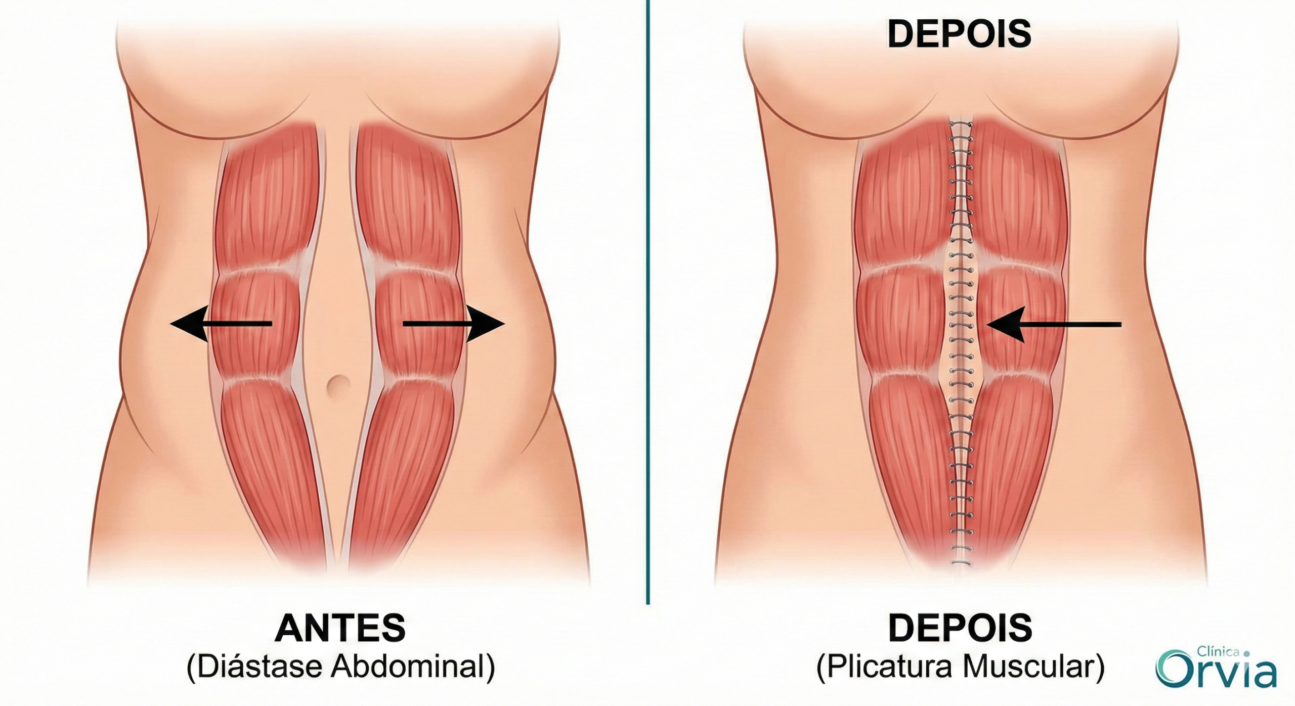 Diagrama médico comparativo: lado esquerdo mostra os músculos abdominais afastados (Diástase) e lado direito mostra os mesmos músculos costurados no centro (Plicatura Muscular) após cirurgia.