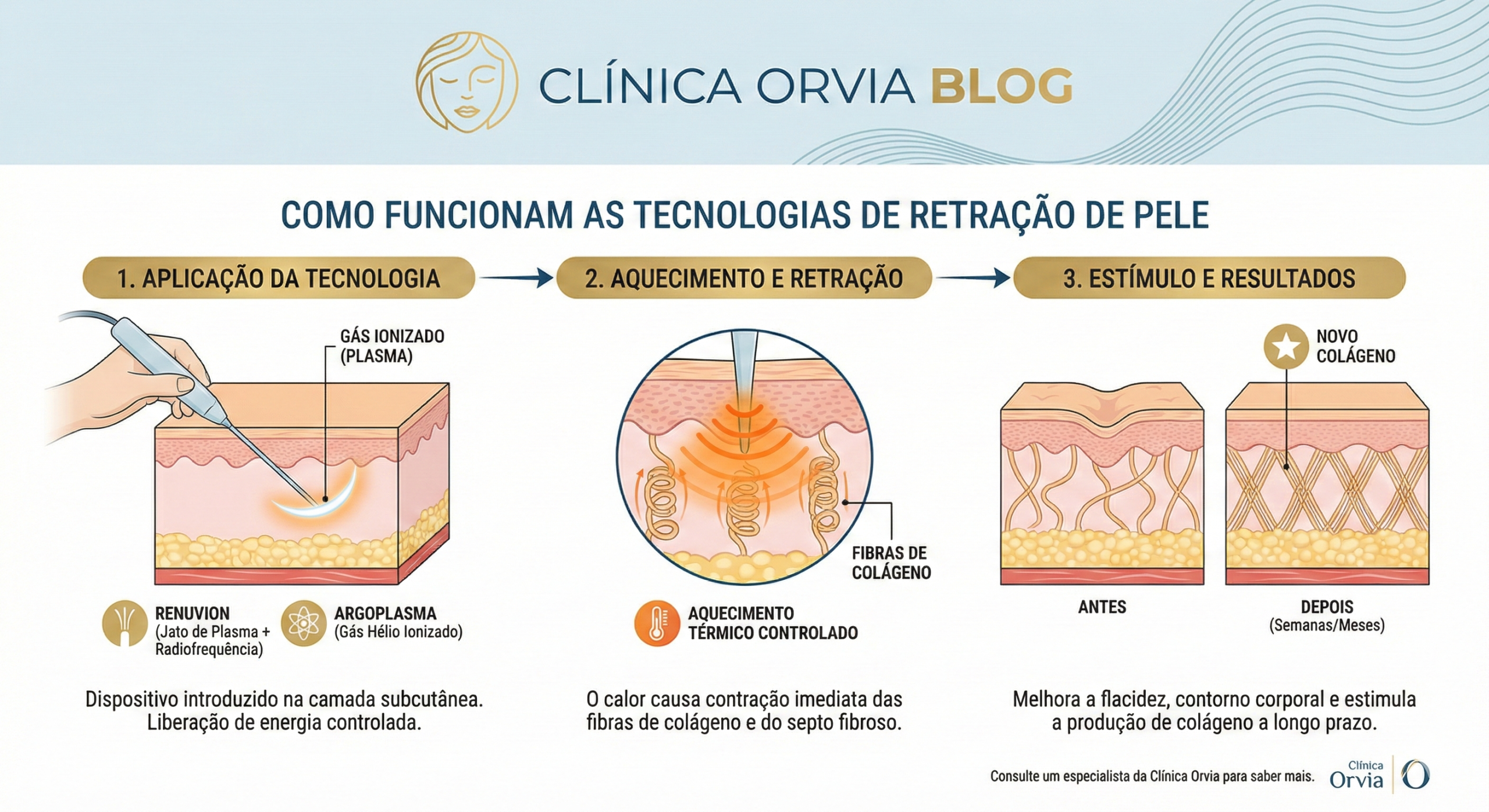 Demonstração cirúrgica de tecnologias de retração de pele atuando no tecido subcutâneo para contrair o colágeno após lipoaspiração.
