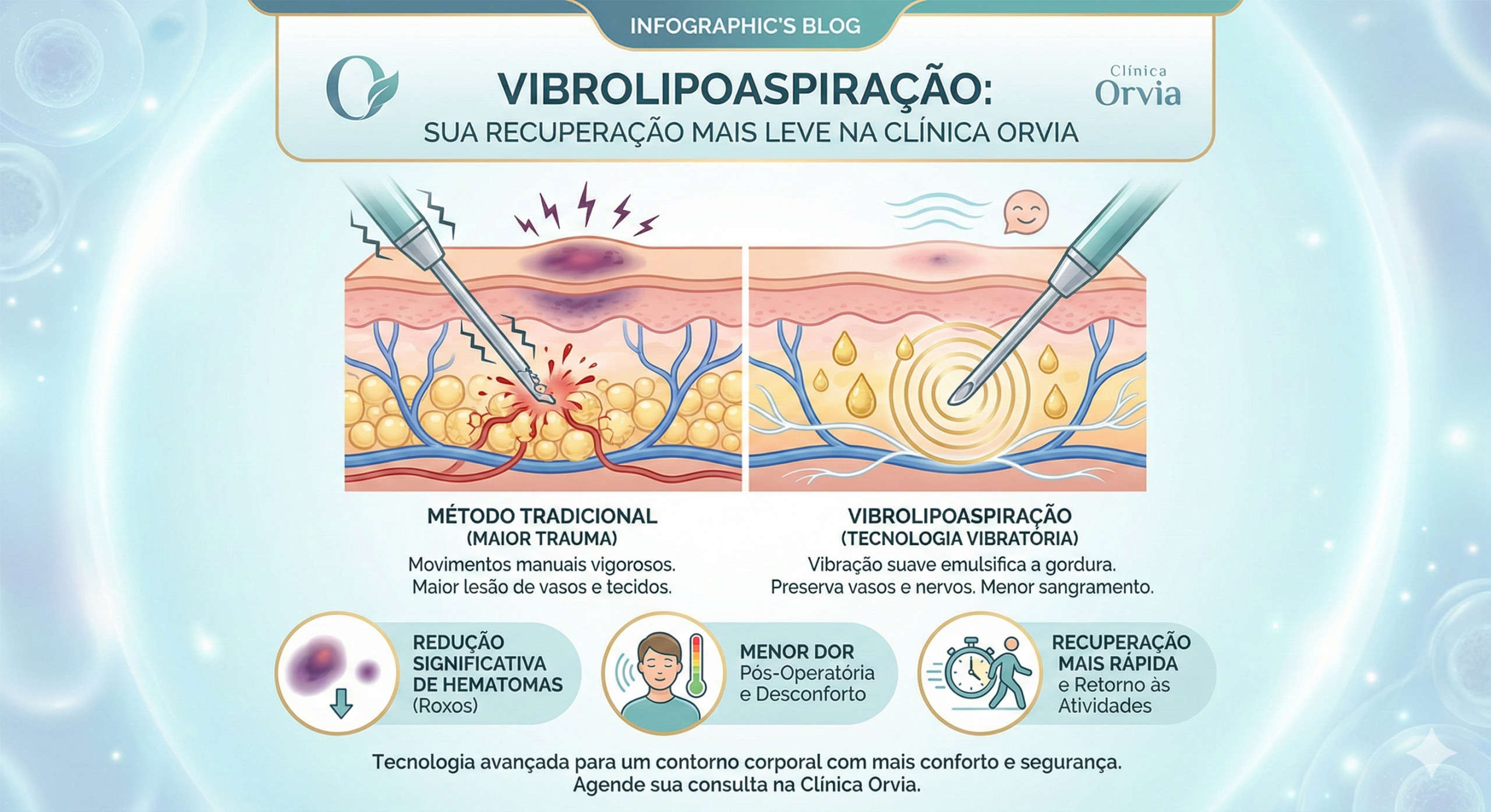 Comparação esquemática do movimento mecânico da Lipo Tradicional com as microvibrações eficientes e seguras da cânula de Vibrolipoaspiração.