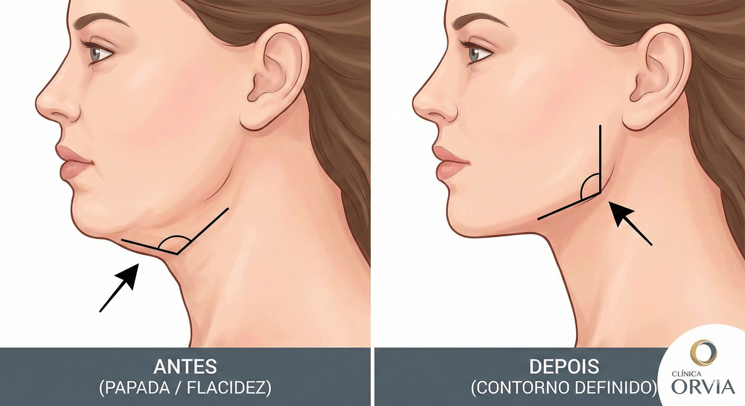 Ilustração comparativa de perfil feminino: lado esquerdo com papada e falta de contorno (ângulo obtuso); lado direito com mandíbula definida e ângulo de pescoço de 90 graus (pós-lifting ou lipo).