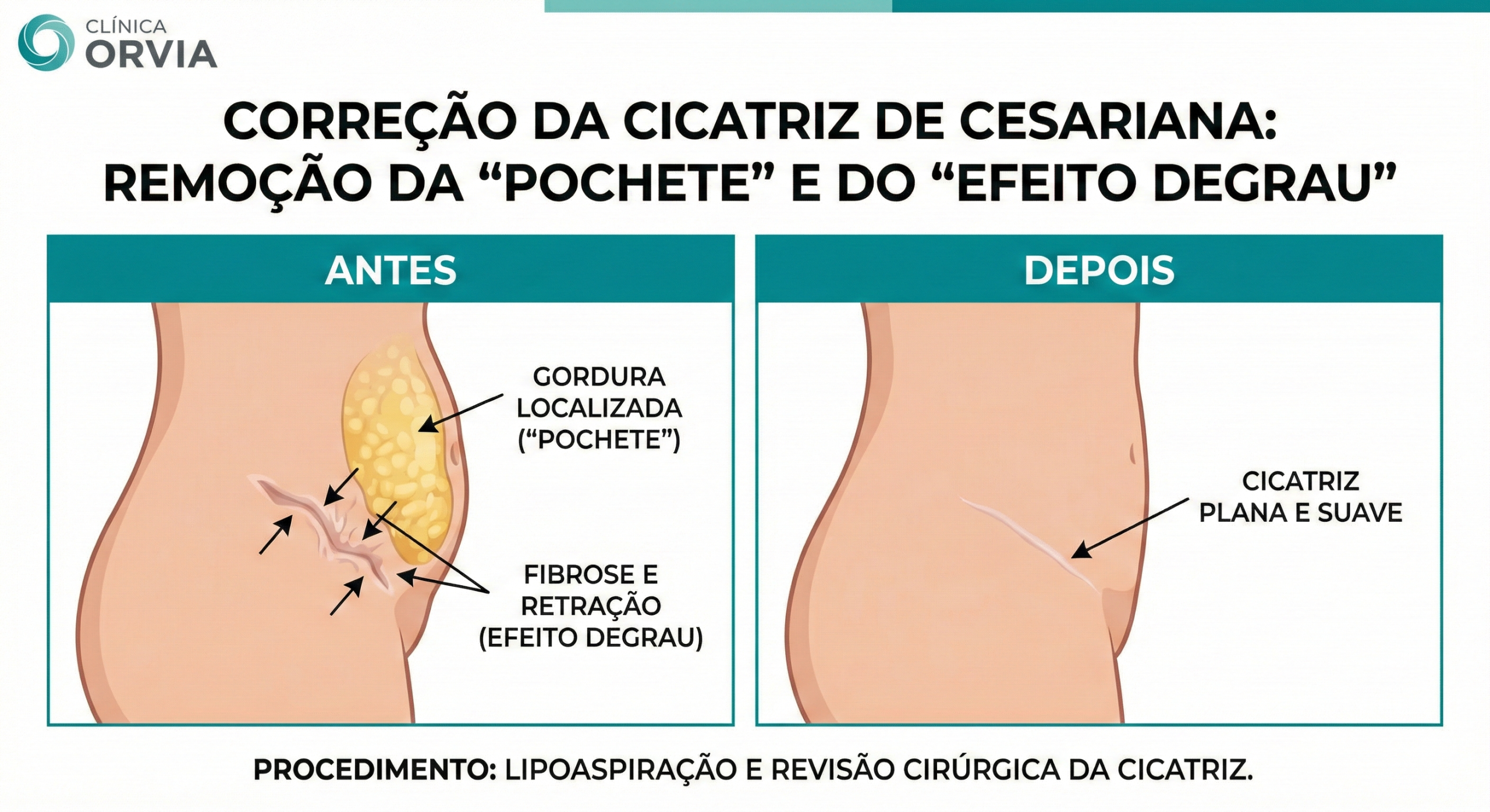 Mulher mostrando o abdômen inferior liso após a correção do degrau de pele e da cicatriz da cesárea através da mini-abdominoplastia.