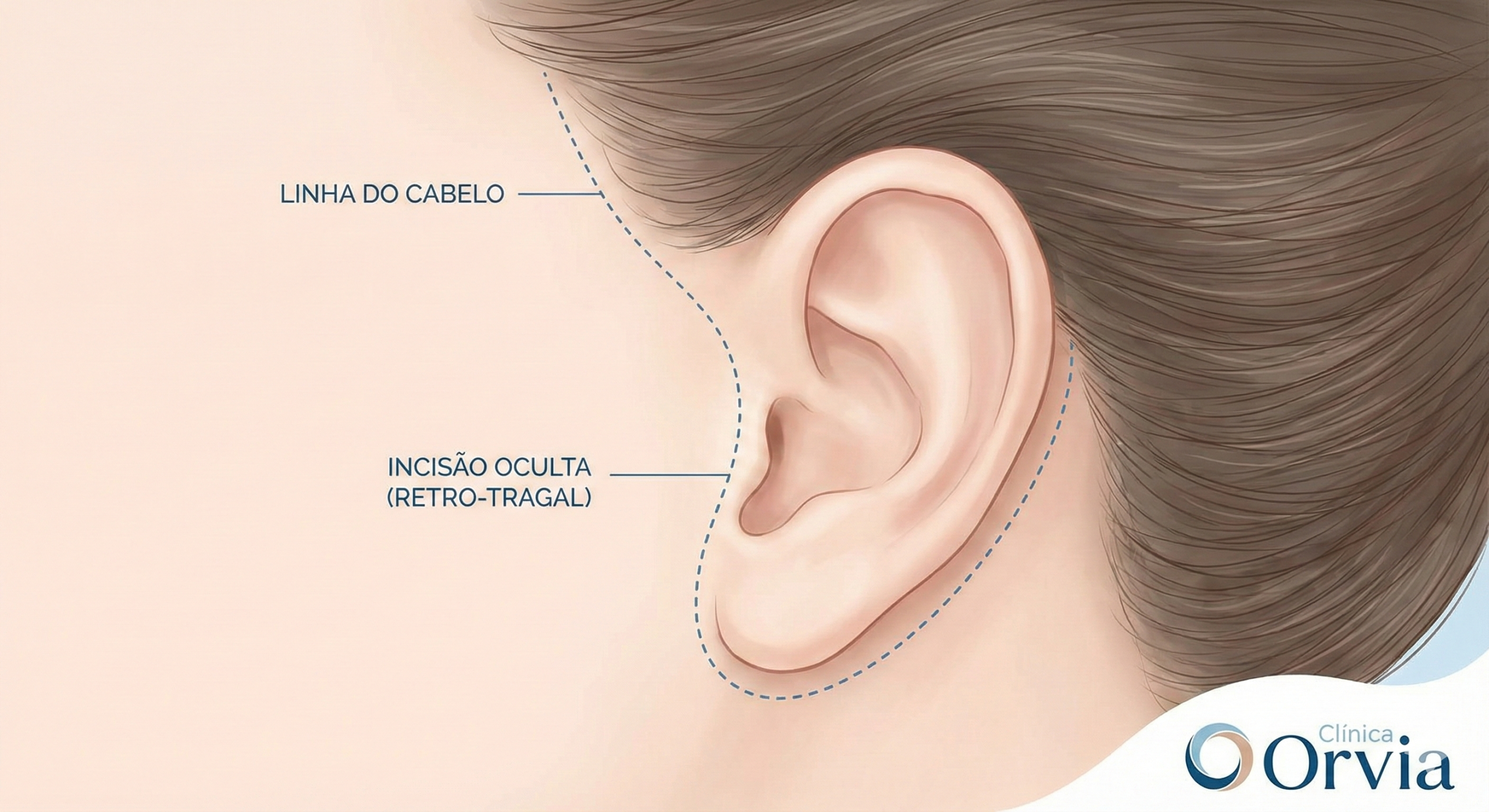 Ilustração médica em close da orelha demonstrando o trajeto da incisão do Lifting Facial. A linha pontilhada indica que o corte fica escondido atrás do tragus (cartilagem) e na linha do cabelo, tornando a cicatriz imperceptível.