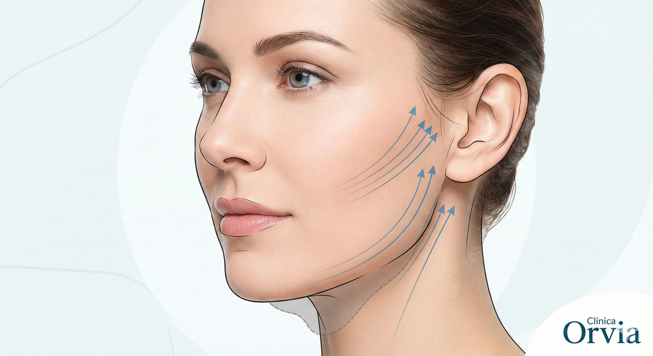Ilustração de rosto feminino jovem (aprox. 40 anos) com vetores (setas azuis) indicando a tração ascendente do Mini Lifting na região da mandíbula e bochechas, corrigindo a flacidez inicial.
