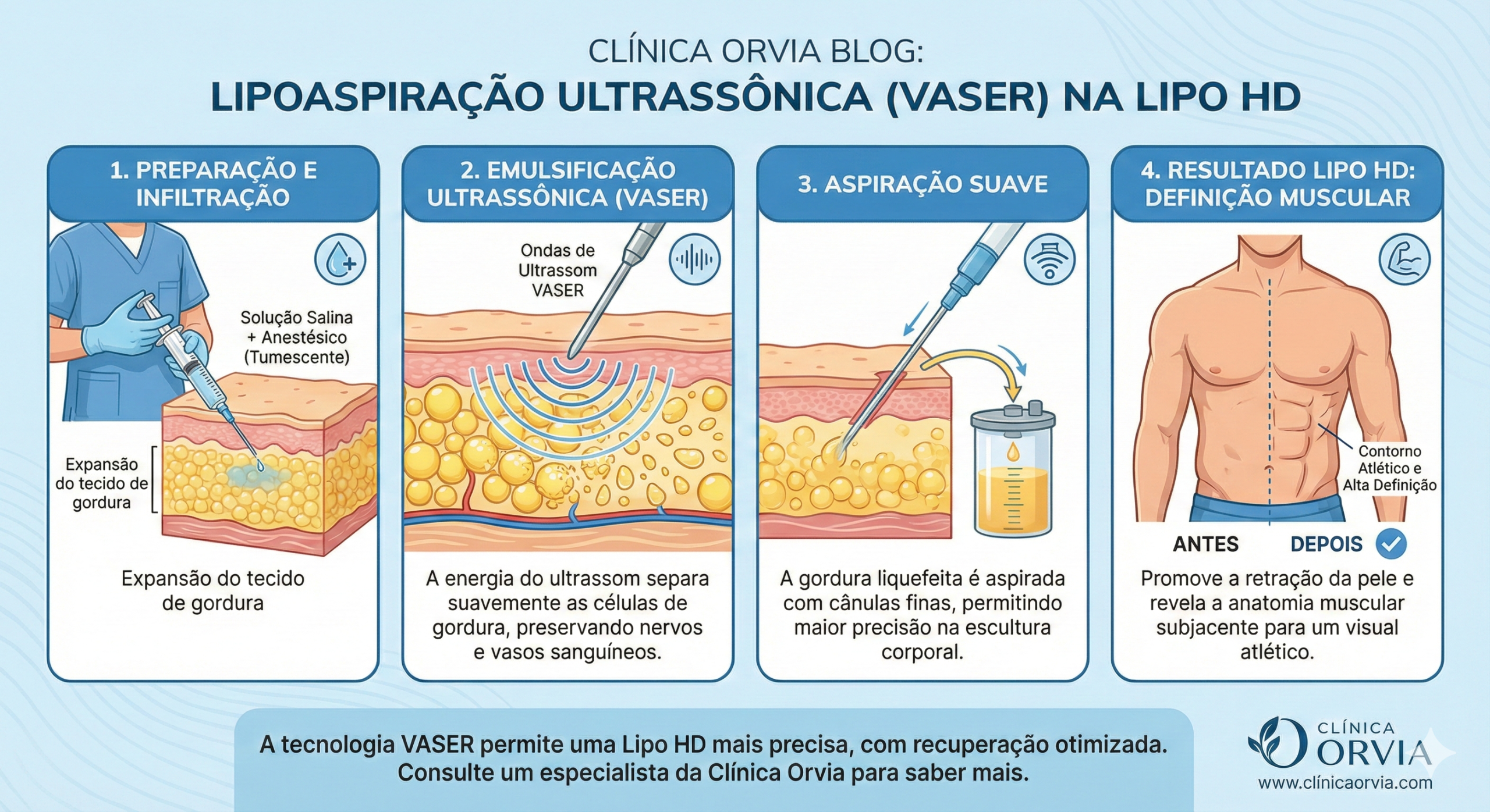Ilustração demonstrando as ondas de ultrassom do VASER Lipo emulsionando as células de gordura antes da aspiração no tecido adiposo.