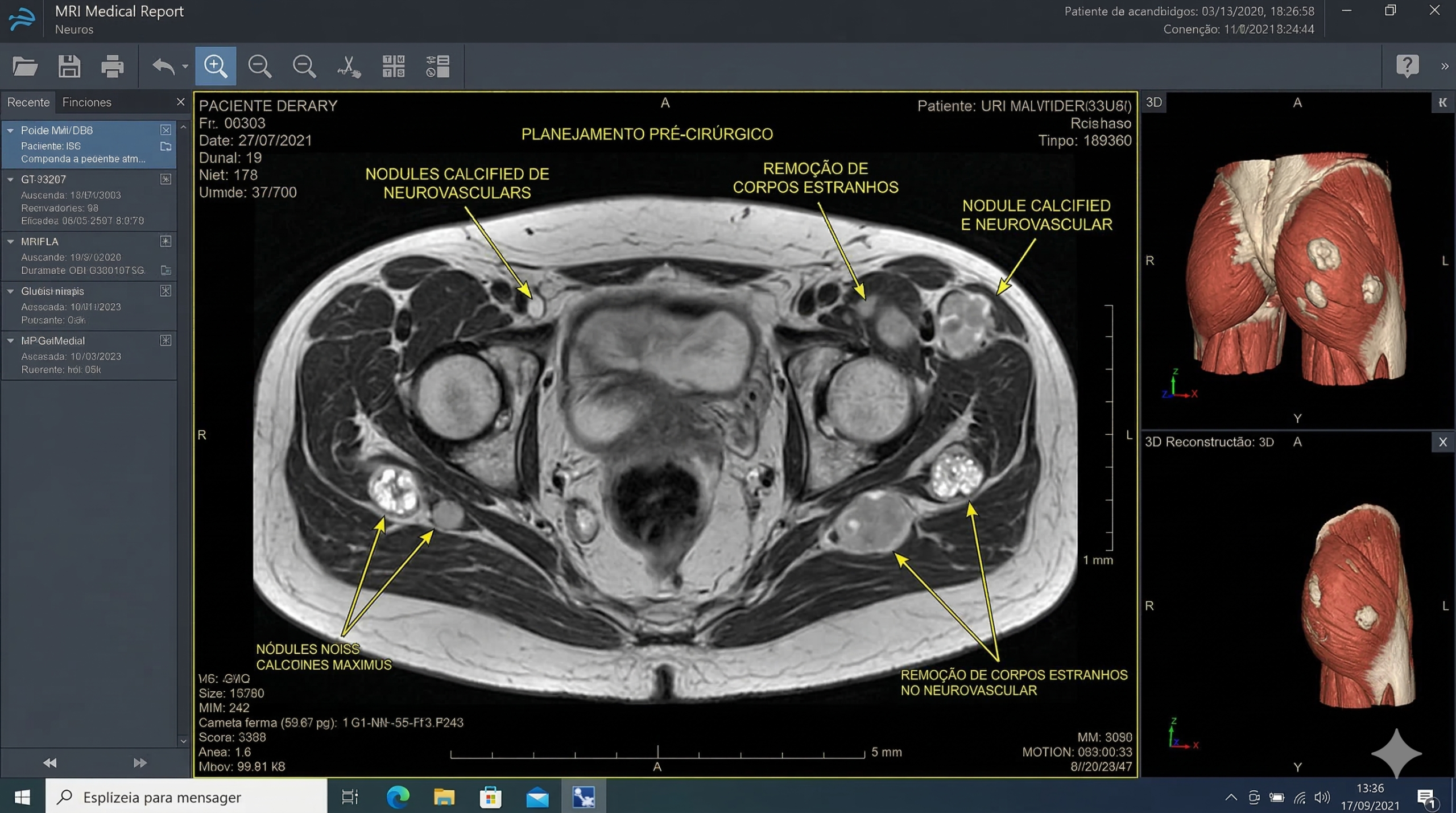 Imagem de ressonância magnética demonstrando nódulos no tecido muscular, servindo como planejamento pré-cirúrgico para a remoção complexa de corpos estranhos da região glútea.